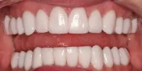 Whitened teeth after treatment in Phoenix, AZ | 24th Street Dental Biltmore