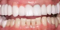 Close-up of teeth dental treatment in Phoenix, AZ | 24th Street Dental Biltmore