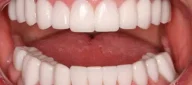 Bright white teeth after dental veneers in Phoenix, AZ | 24th Street Dental Biltmore