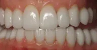 Before teeth with staining and crowding in Phoenix, AZ | 24th Street Dental Biltmore