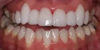 Upper veneers with lower teeth discoloration in Phoenix, AZ | 24th Street Dental Biltmore