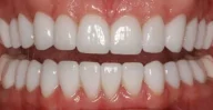 Close-up of teeth after treatment in Phoenix, AZ | 24th Street Dental Biltmore