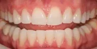 Close-up of teeth after treatment in Phoenix, AZ | 24th Street Dental Biltmore