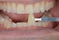 Tooth shade match crown in Phoenix, AZ | 24th Street Dental Biltmore