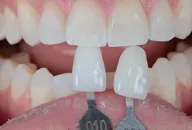 Tooth shade match after crown in Phoenix, AZ | 24th Street Dental Biltmore