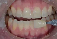 Tooth shade match before crown in Phoenix, AZ | 24th Street Dental Biltmore