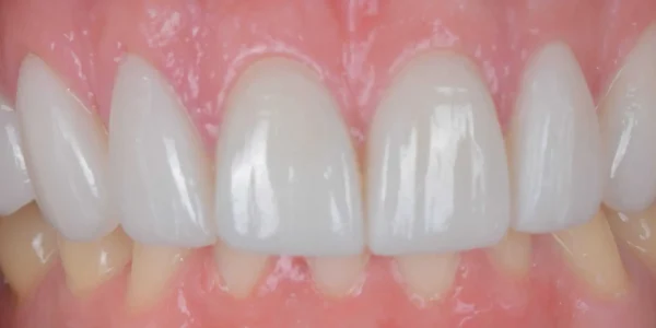Close-up of teeth after treatment in Phoenix, AZ | 24th Street Dental Biltmore