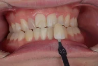 Tooth shade match crown in Phoenix, AZ | 24th Street Dental Biltmore