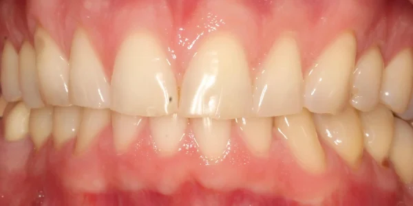 Close-up of teeth before treatment in Phoenix, AZ | 24th Street Dental Biltmore