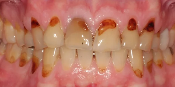 Close-up of teeth before treatment in Phoenix, AZ | 24th Street Dental Biltmore