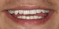 Close-up of teeth after treatment in Phoenix, AZ | 24th Street Dental Biltmore