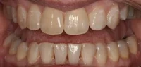 Close-up of teeth after treatment in Phoenix, AZ | 24th Street Dental Biltmore