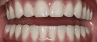 Close-up of teeth after treatment in Phoenix, AZ | 24th Street Dental Biltmore