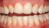 Close-up of teeth dental treatment in Phoenix, AZ | 24th Street Dental Biltmore