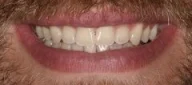 Close-up of teeth after treatment in Phoenix, AZ | 24th Street Dental Biltmore