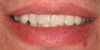 Close-up of teeth dental treatment in Phoenix, AZ | 24th Street Dental Biltmore