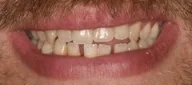 Close-up of teeth before treatment in Phoenix, AZ | 24th Street Dental Biltmore