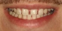Close-up of teeth before treatment in Phoenix, AZ | 24th Street Dental Biltmore
