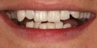 Close-up of teeth before treatment in Phoenix, AZ | 24th Street Dental Biltmore