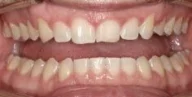 Close-up of teeth after treatment in Phoenix, AZ | 24th Street Dental Biltmore