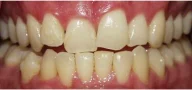 Close-up of teeth before treatment in Phoenix, AZ | 24th Street Dental Biltmore