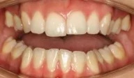 Close-up of teeth before treatment in Phoenix, AZ | 24th Street Dental Biltmore
