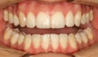 Close-up of teeth after treatment in Phoenix, AZ | 24th Street Dental Biltmore